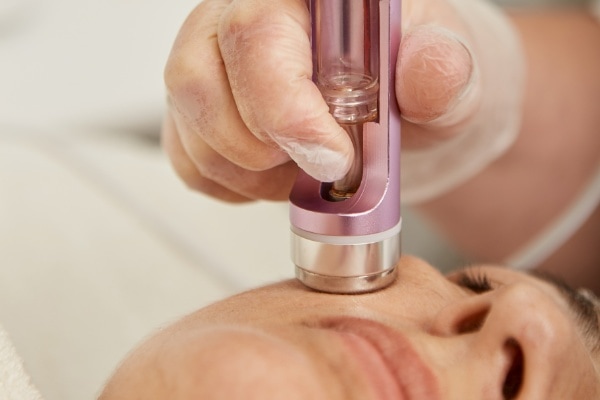 Microneedling | Wellness Compleet Almelo | Microneedling percutane collagen inductie Microneedling (percutane collagen inductie)
